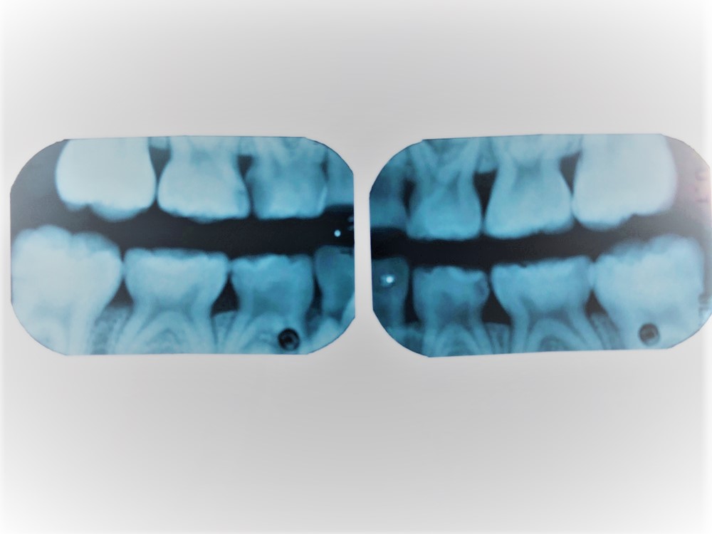 お子さんの歯を守るために